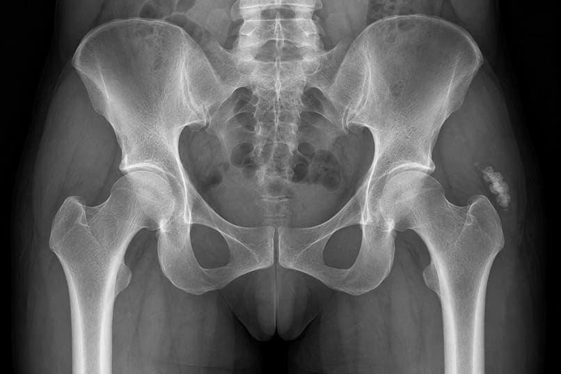 calcificazione dell'anca