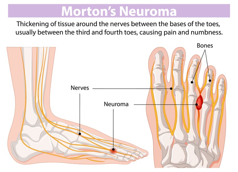 neuroma di morton