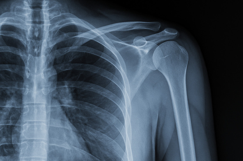 radiografia spalla